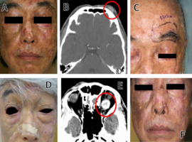 Successful Use of Anti-PD-1 Antibody to Treat Multiple Metastatic Carcinomas in a Patient with Xeroderma Pigmentosum: Case Report and Literature Review