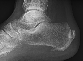 Effects of the Shock Wave Therapy Application in Treatment of Heel Thorn: Calcar Calcanei