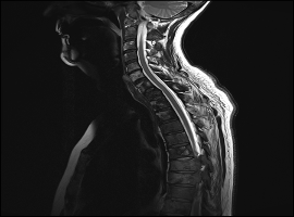 A Case-Matched Study Comparing Surgery to No Surgery in Patients with Metastatic Spinal Cord Compression