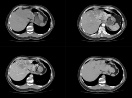 Diffuse Hepatic Hemangiomatosis with Left-Lobe Predominance