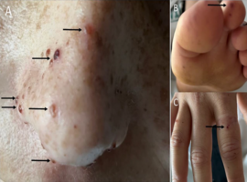 Diag-nose-ing Septic Emboli