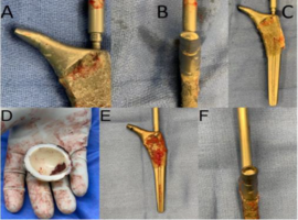 Gross Trunnion Failure of the Accolade I Femoral Stem with Metal-on Polyethylene Eccentric Wear: A Report of 2 Cases