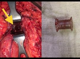 Misplaced Lumen Apposing Metallic Stent: An Open Surgery