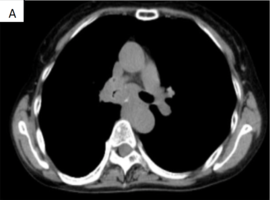 A Case of Middle Mediastinal Thymic Carcinoma with Pulmonary Cavitaion and Pneumothorax after Lenvatinib Administration