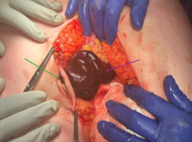 Strangulated Small Bowel Obstruction in an Umbilical Hernia: A Case Report of Surgical Misadventure with a Positive Surgical Outcome
