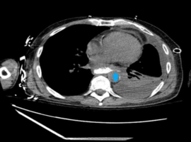 Esophageal Candidiasis Complicated by Bronchoesophageal Fistula