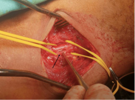 Migration of a Jugular Hemodialysis Catheter Revealed by Edema of the Left Upper Limb