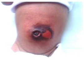 Misdiagnosed Umbilical Granuloma Resulting in Umbilical Burns Due to Improper Application of Silver Nitrate in New-Borns