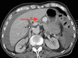 Endovascular Management of a Gastric Artery Aneurysm Rupture