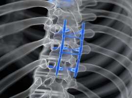 Outpatient vs Inpatient Lumbar Fusion
