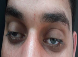 Isolated Binocular Diplopia and Ptosis: A Rare Presentation of Snakebite