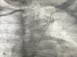 Dynamic Fluoroscopic Recognition of Chronic Subclavian Vein Occlusion During CIED Implantation: Mechanobiological Remodeling and Functional Venous Patency
