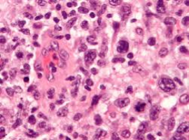 Anaplastic Large Cell Lymphoma Involving the Bladder: Rare Involvement of a Rare Malignancy