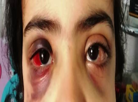 Ocular Manifestations of Acute Myeloid Leukemia