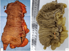 Inflammatory Myoglandular Colonic Polyp with Adenomatous Changes Mimicking Malignant Tumor