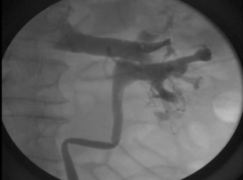 An Exceptionally Rare Retrograde Pyelogram Finding with an Unexpected Cause