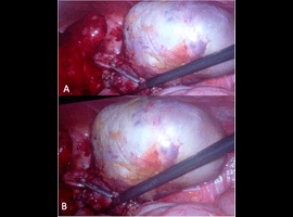 Tubo-Ovarian Teratoma: MRI Essential Problem-Solving Tool. Case Report and Review of Literature
