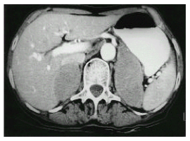 Clinical Image of Metastatic Non Hodgkins Lymphoma Manifesting as Bilateral Adrenal Masses