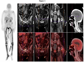 Tibial Intravascular Large B-Cell Lymphoma