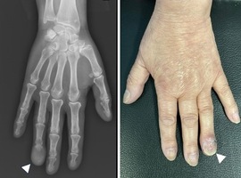 Acral Metastasis of Oral Squamous Cell Carcinoma: A Rare Presentation