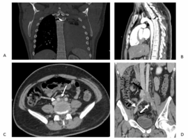 A Bullet in the Thoracic Spine and May-Thurner Syndrome