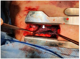 A Case of a 68 Year Old Male with Bilateral Giant Bullous Emphysema: A Case Report