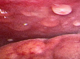 Visualizing Early Pleuritis During Talc Poudrage: A Thoracoscopic Perspective