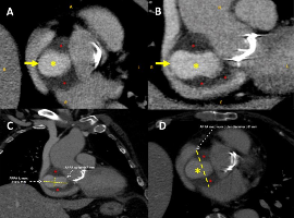 Long-Term Follow-Up after Percutaneous Closure of Large Aortic Root Pseudoaneurysm with a Flex II Atrial Septal Defect Occluder: A Case Report
