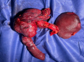 Total Duodenopancreatectomy for Intraductal Papillary Mucinous Tumor