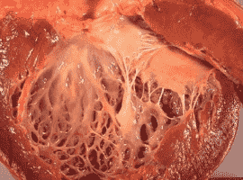A Clinical Case on Coronary Artery Disease