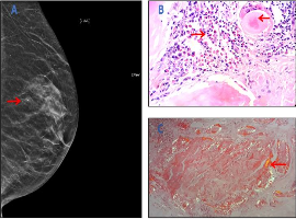 A Case of Localised Breast AL Kappa type Amyloid Deposition