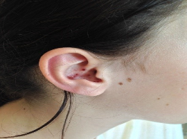 Peripheral Facial Palsy in an Adolescent: A Ramsay Hunt Syndrome Diagnosis