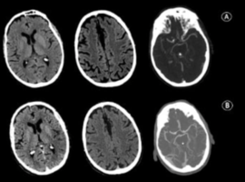 Ischemic Core Underestimation: A Perfusion Scotoma Case