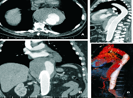Giant Thoracoabdominal Aortic Aneurysm after EVAR