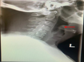 Endoscopic View of Epiglottitis - An Uncommon Presentation in Adults