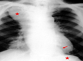 Huge Para-esophageal Mass of the Mediastinum Mimicking Achalasia: Case Report