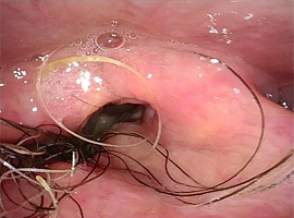 Treatment of Intractable Hair Growth After Partial Laryngectomy