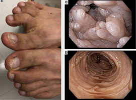 Cronkhite-Canada Syndrome Presenting as Acute Diarrhea