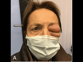 Recall Phenomenon After Intracranial Stereotactic Radiotherapy: Illustration of a Palpebral Reaction