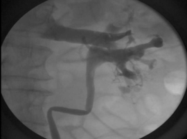 An Exceptionally Rare Retrograde Pyelogram Finding with an Unexpected Cause