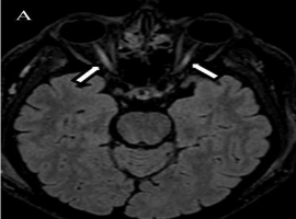 Acute Blindness After Lower Limb Injury