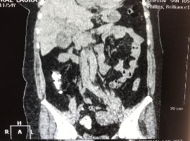Gallbladder Adenocarcinoma Associated with Small Cell Tumor Neuroendocrine Collision Tumor: A Rare Case in the Literature and Review
