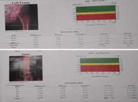 Results of Genetic Diagnosis and FRAX Model vs Results of DEXA 1-0