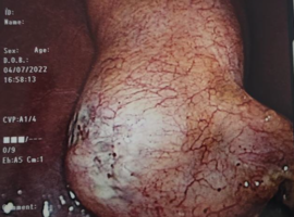 A Case Report of Acute Cholecystitis and Acute Appendicitis in a Patient with COVID – 19 Infection: Double Jeopardy or a Triple Threat?