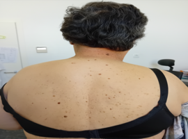 Aggressive Fibromatosis: A Rare Diagnosis