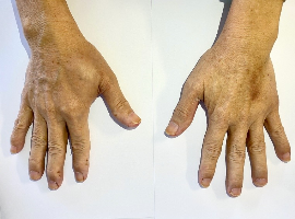 Transformation from Myositis to Mycotic Aneurysm in Infective Endocarditis