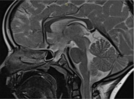 Persistent Hypophyseal or Craniopharyngeal Canal: A Rare Defect