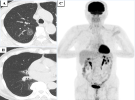 Pulmonary Typical Carcinoid on Right Middle Lobe Hypoplasia: A Case Report and Review of the Literature