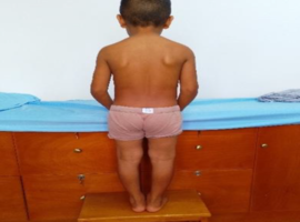 X-Linked Hypophosphatemic Rickets: A Report of Three Sisters with a Variant in the PHEX Gene with Healthy Parents, One of Them with Two Affected Children