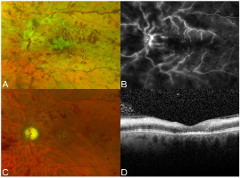 Vascular Sheathing from Ischemic Central Retinal Vein Occlusion